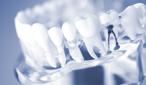 根管治療 (歯内療法)